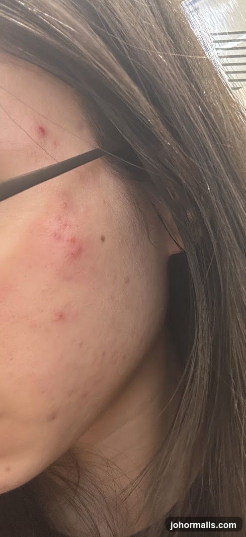 Close-up of a person's face with acne
