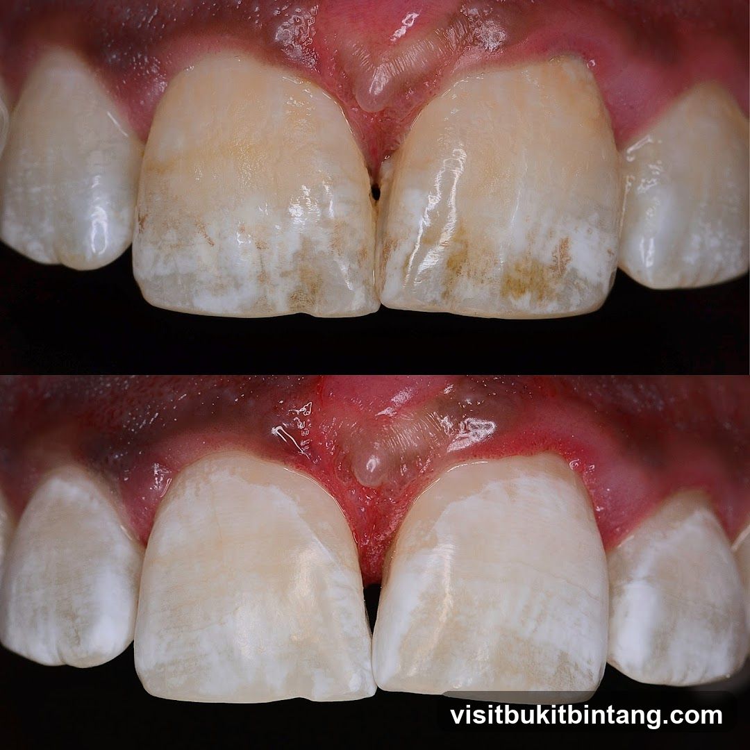 Before and After Dental Treatment