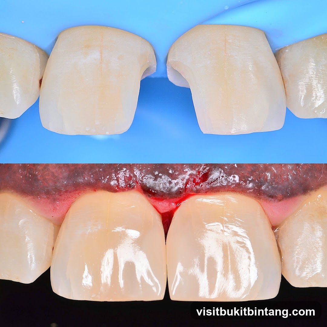 Dental Crowns and Gums