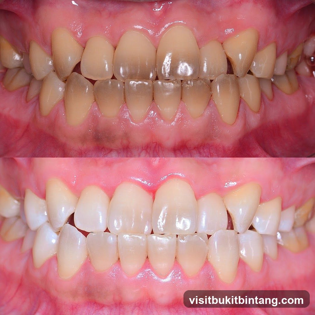 Before and After Teeth Whitening