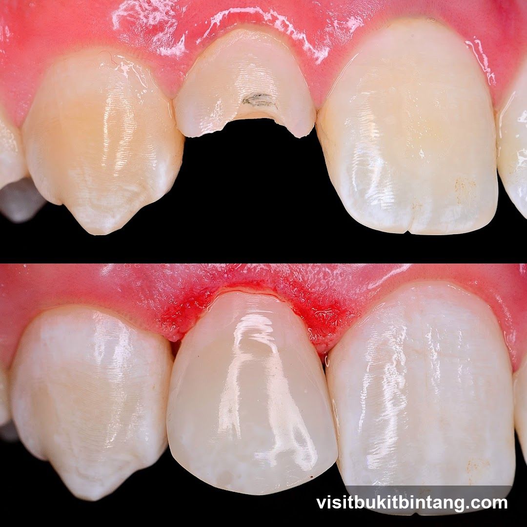 Dental Restoration