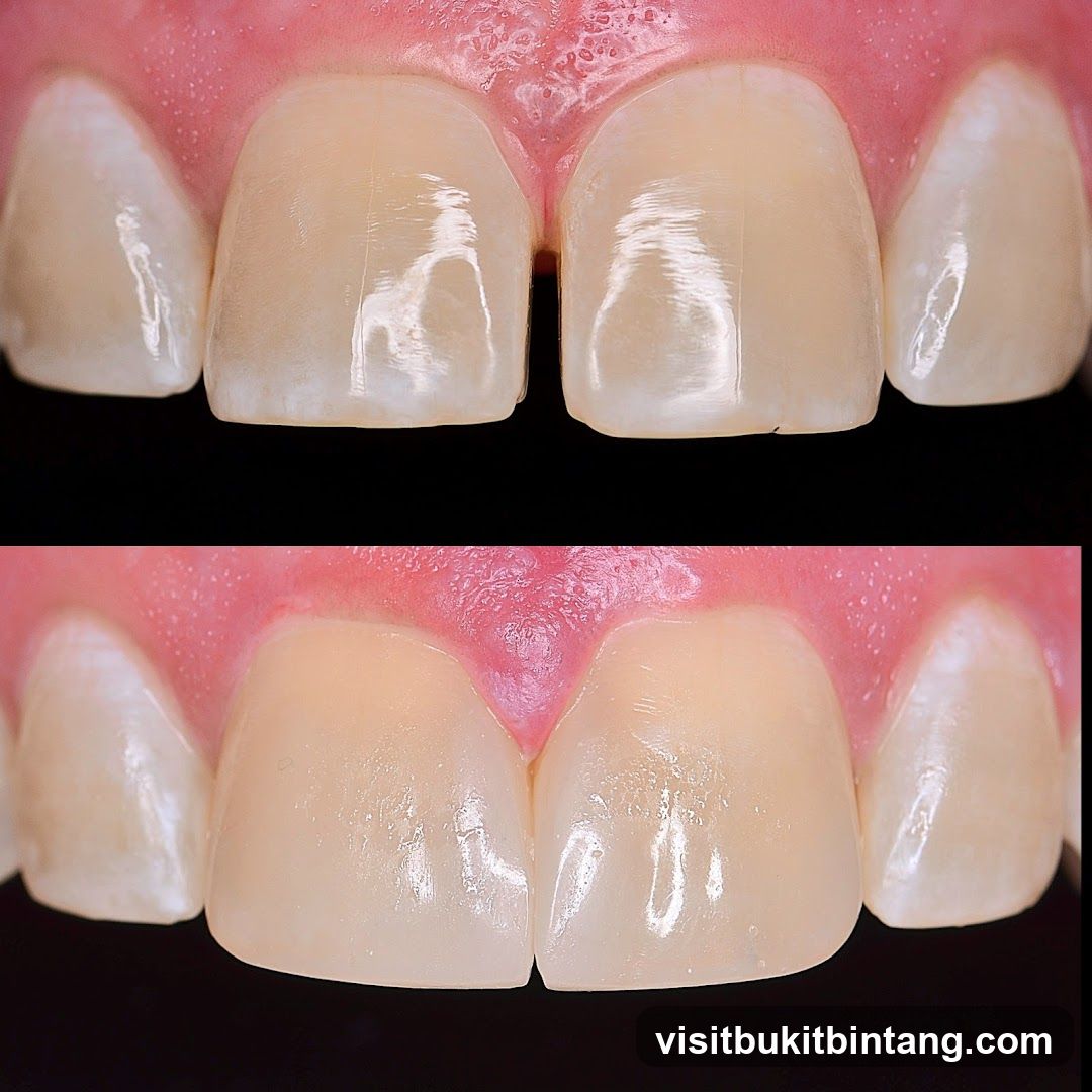 Dental Veneers