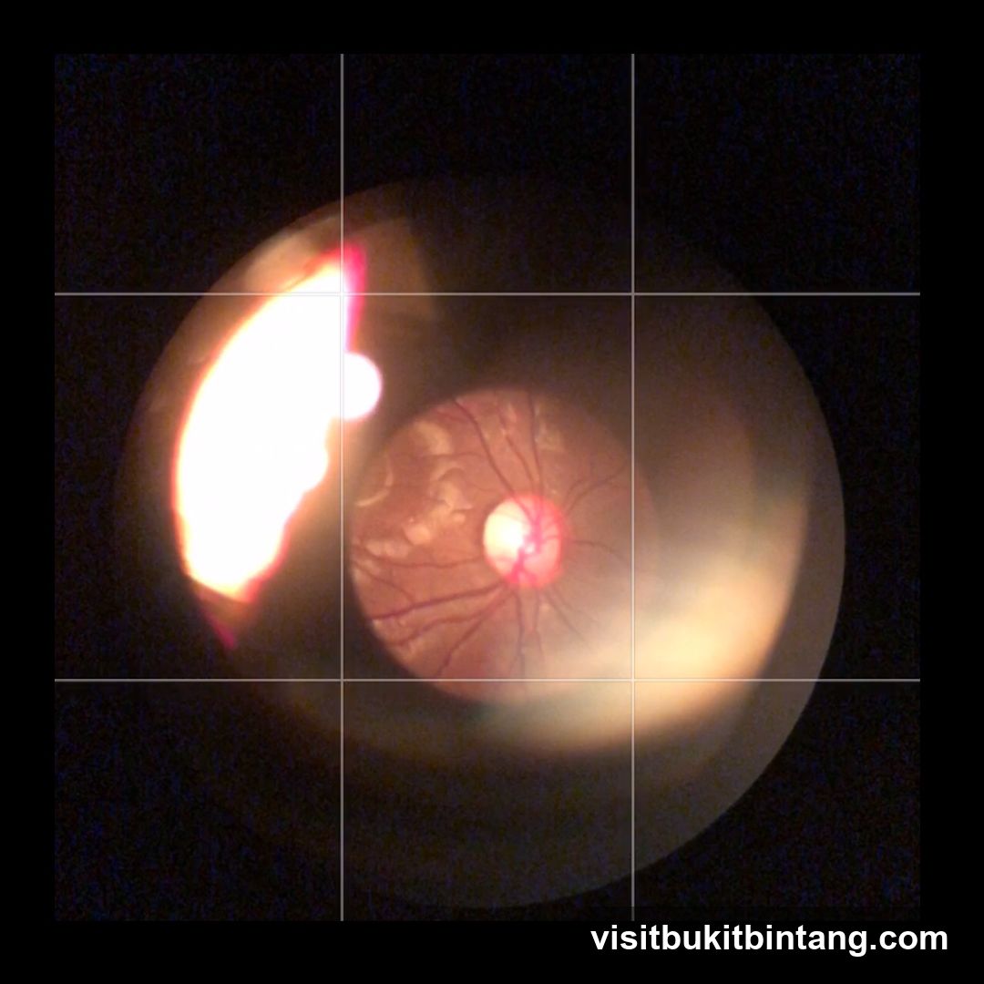 Ophthalmoscopic Image of the Retina
