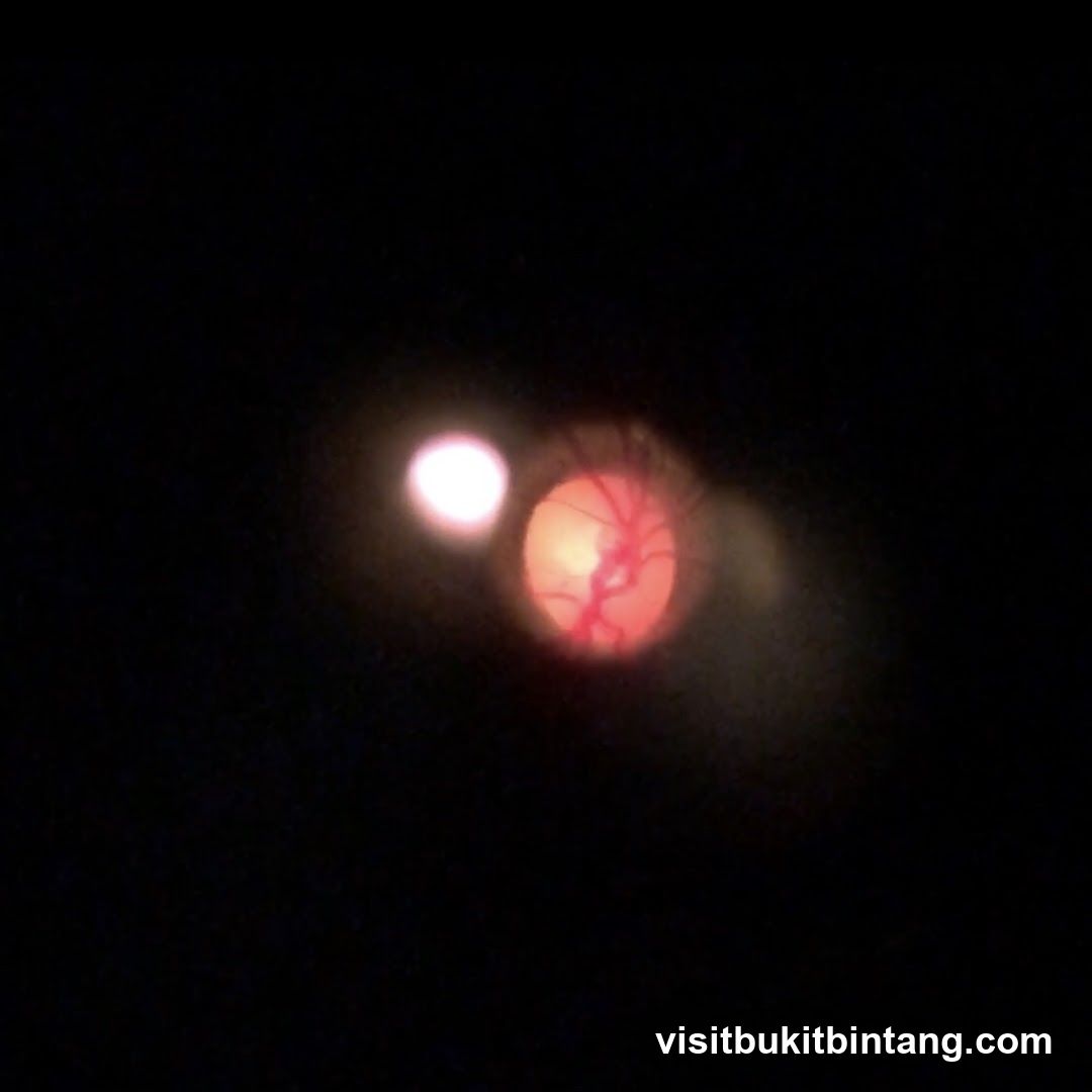 Ophthalmoscope View