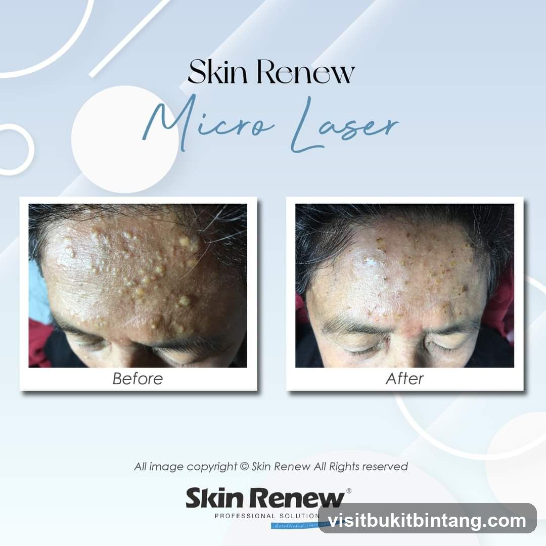 Skin Renew Micro Laser Before and After