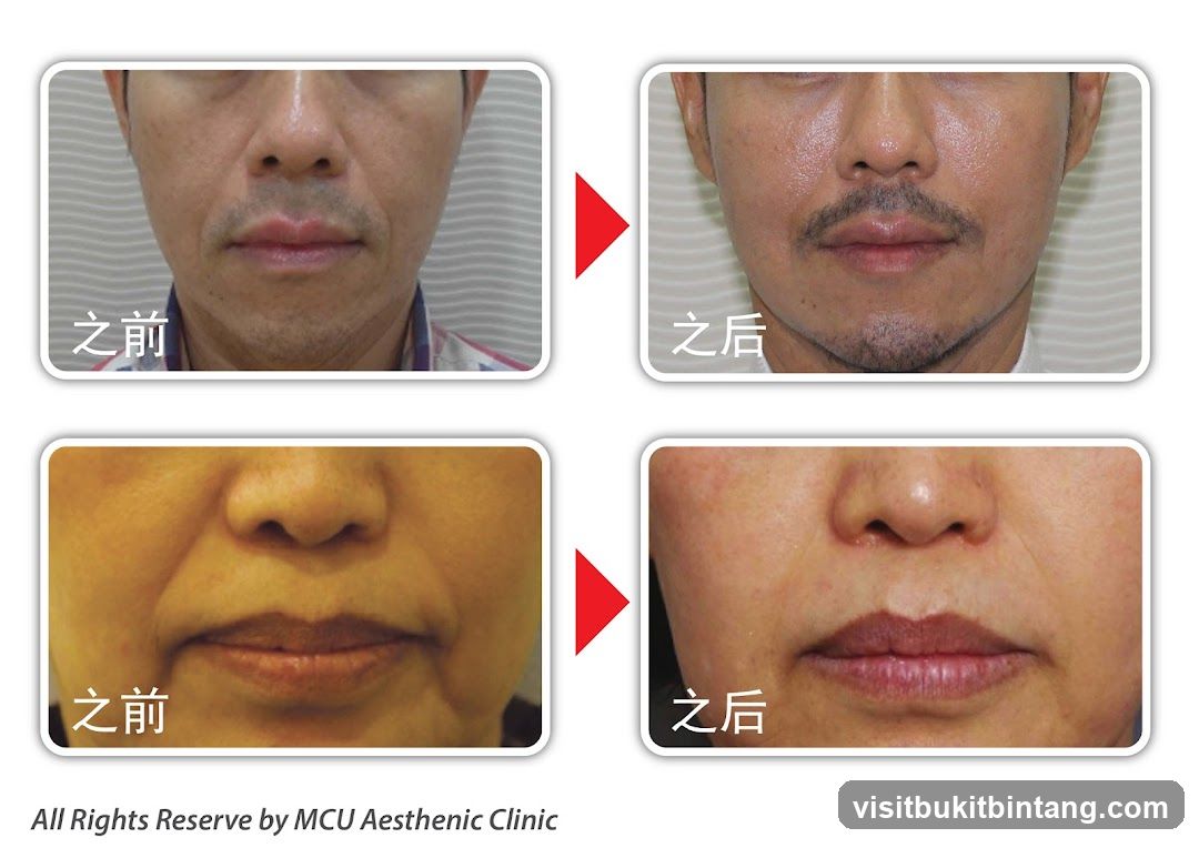 Before and After Cosmetic Procedure