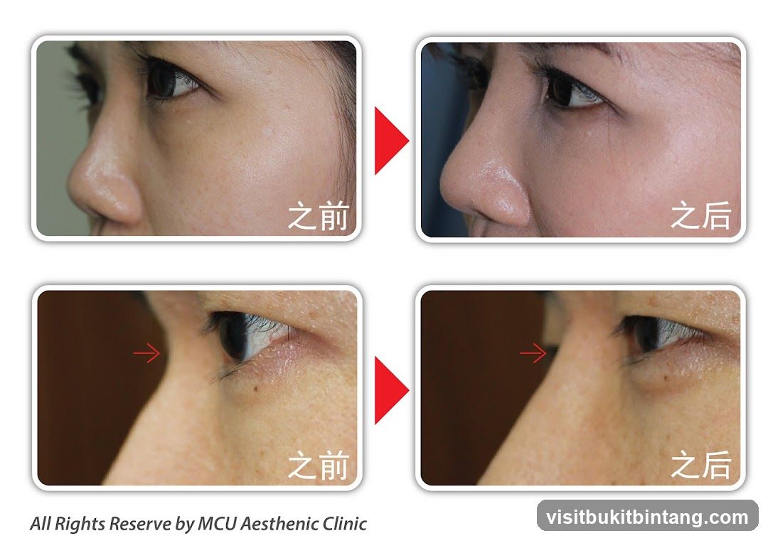 Before and After Cosmetic Procedure