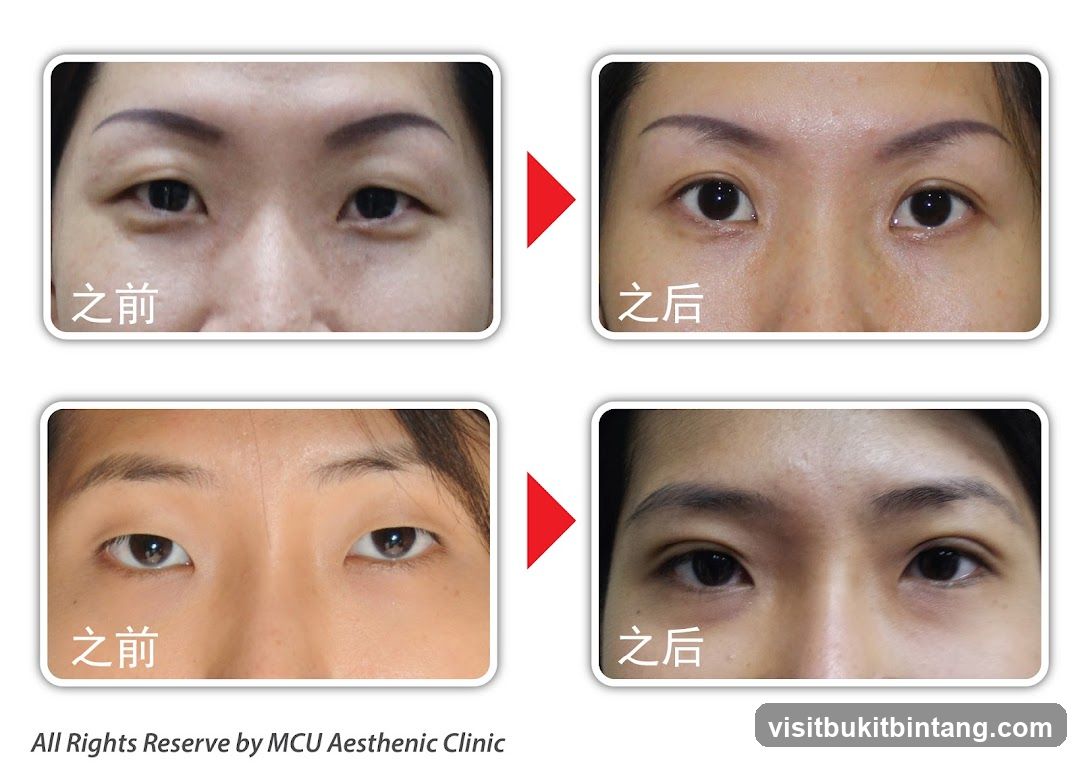 Before and After Eye Surgery