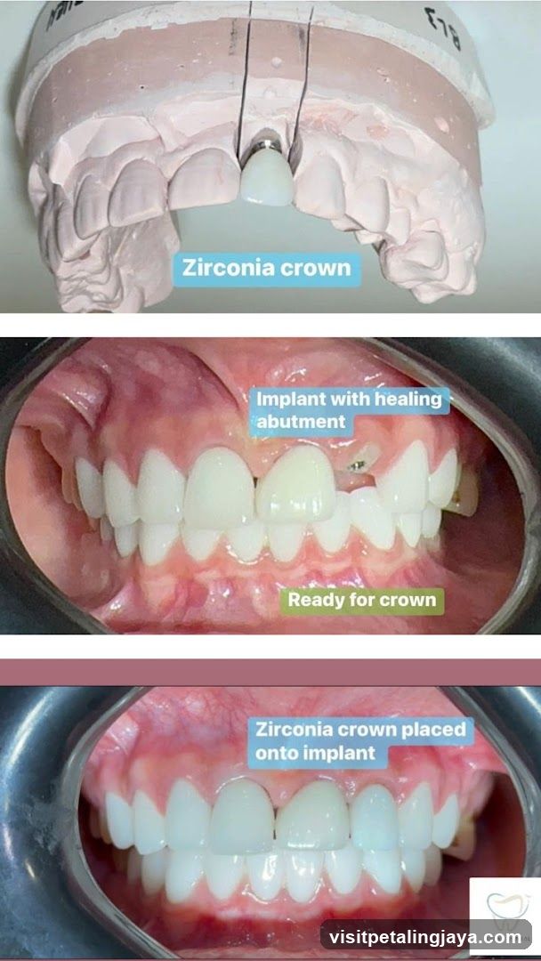 Dental Implant and Zirconia Crown Process