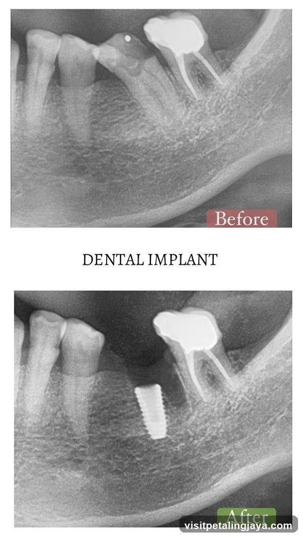 Dental Implant X-Ray Comparison