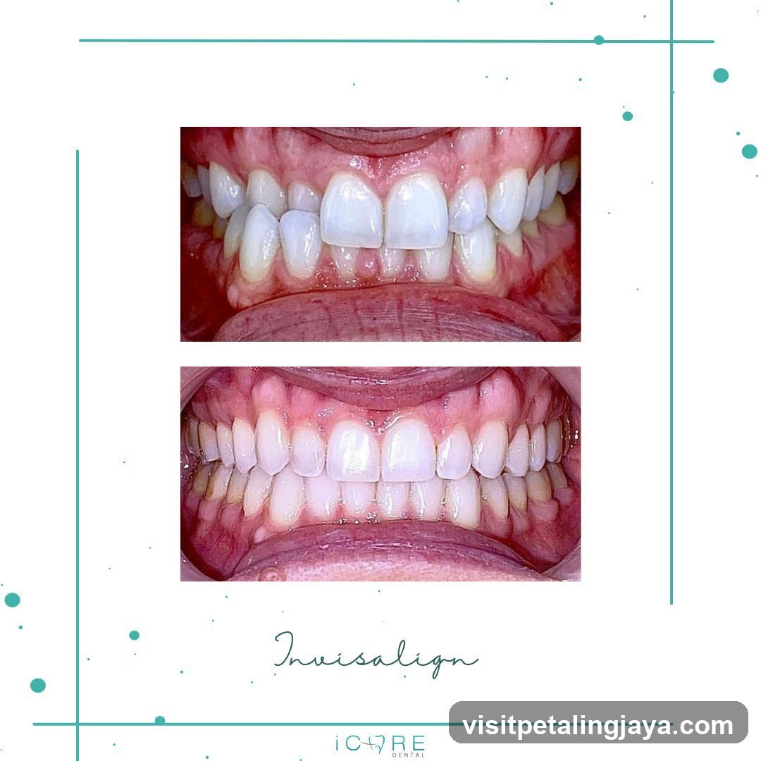 Invisalign Before and After