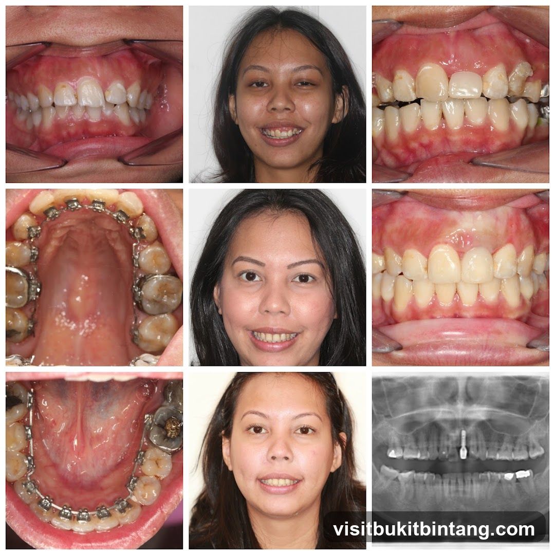 Dental Progress Photos