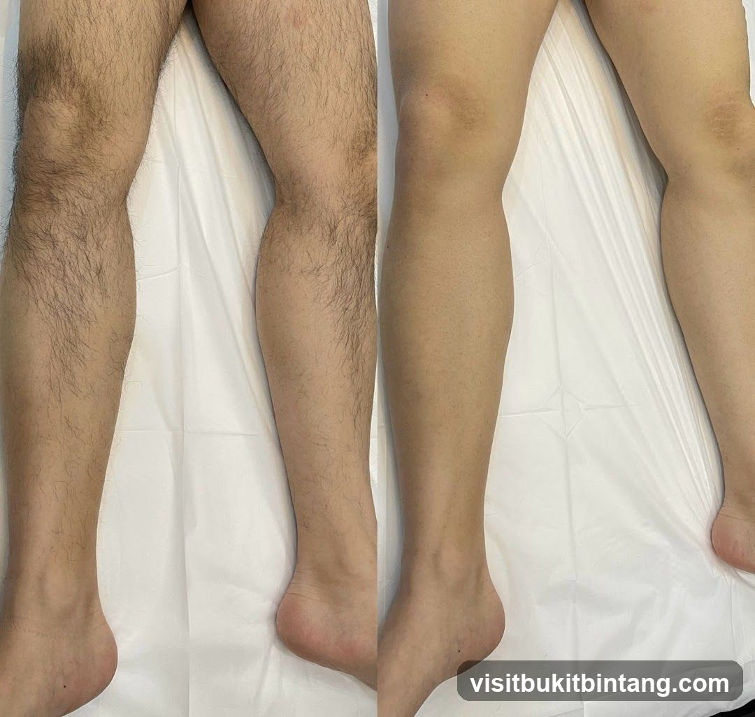 Leg Hair Removal Before and After