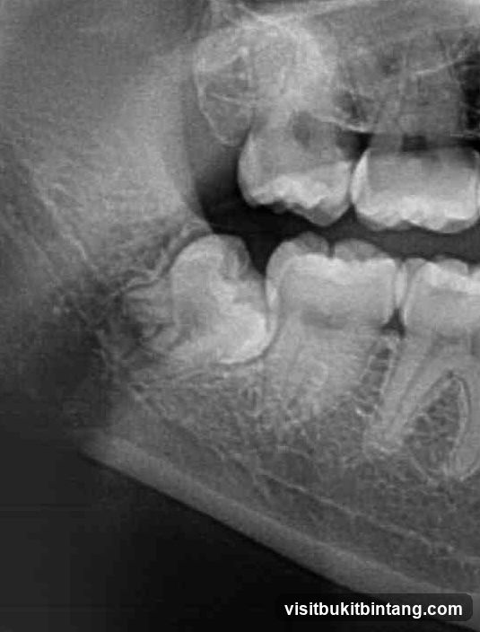 Dental X-ray