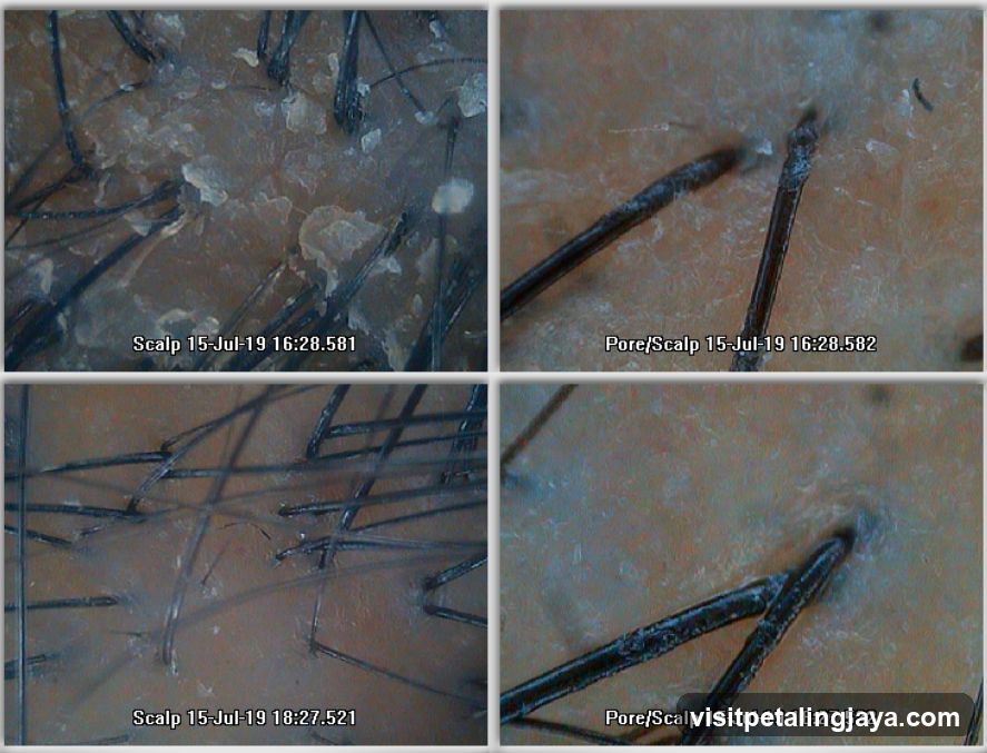Dermatoscopy of Scalp and Pore