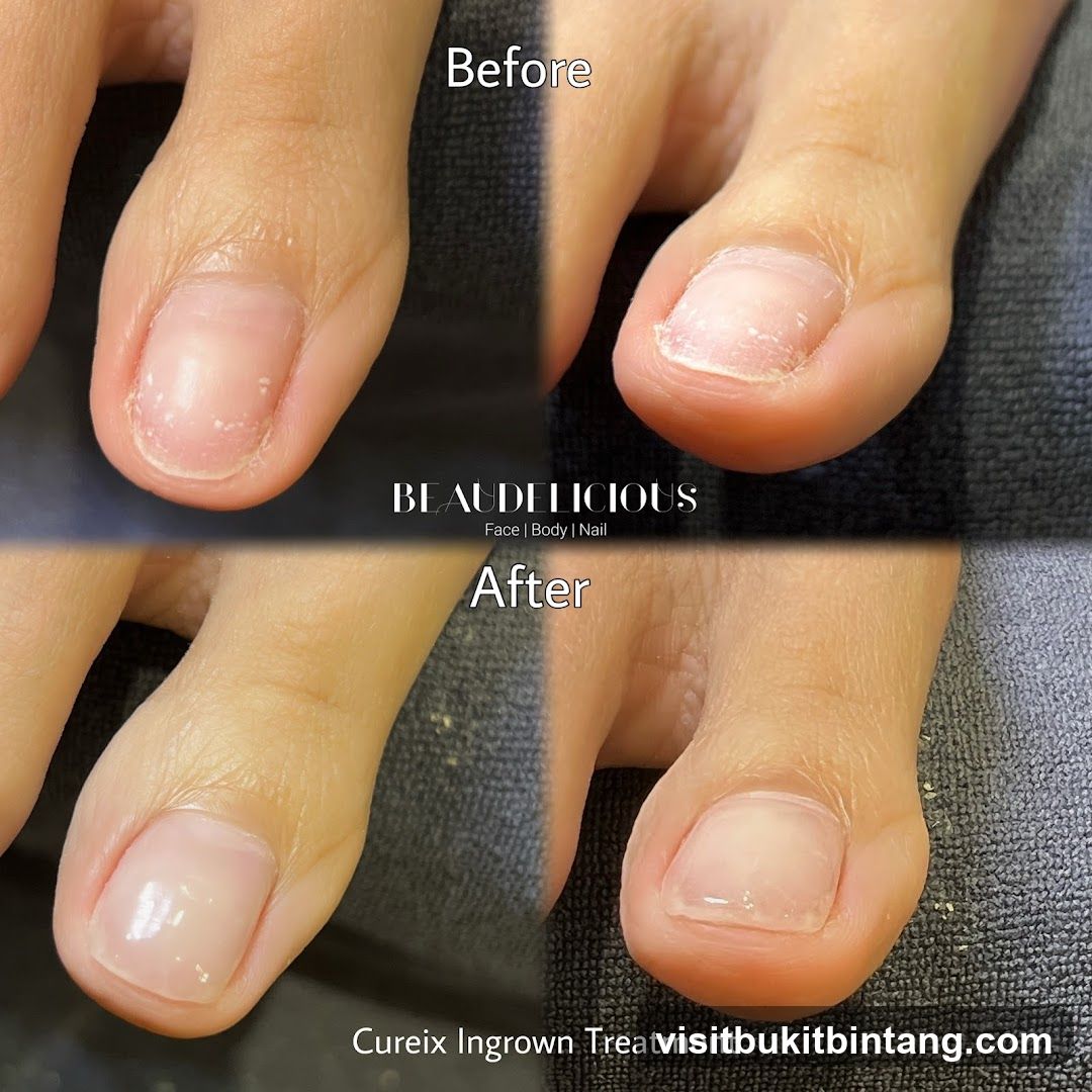 Ingrown Toenail Treatment Before and After