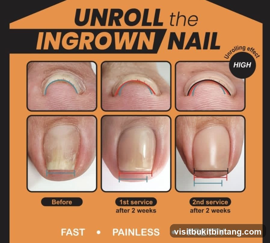 Unroll the Ingrown Nail