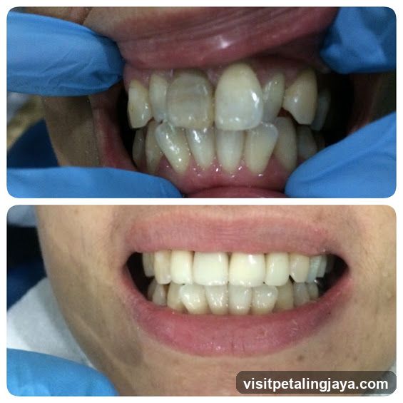 Dental Treatment Before and After
