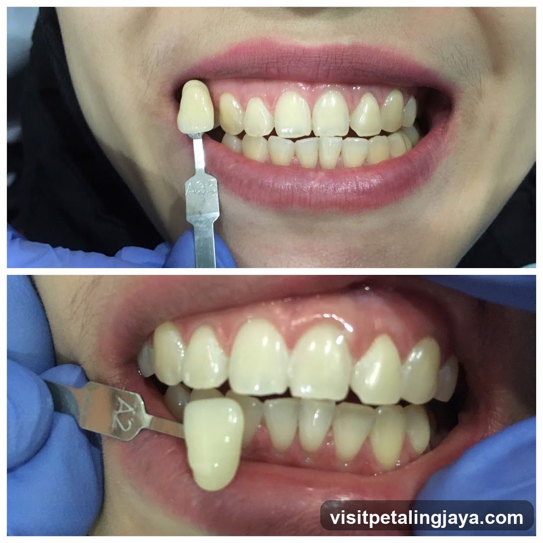 Dental Shade Selection