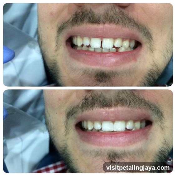 Dental Treatment Before and After