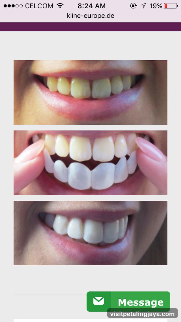 Dental Treatment Before and After