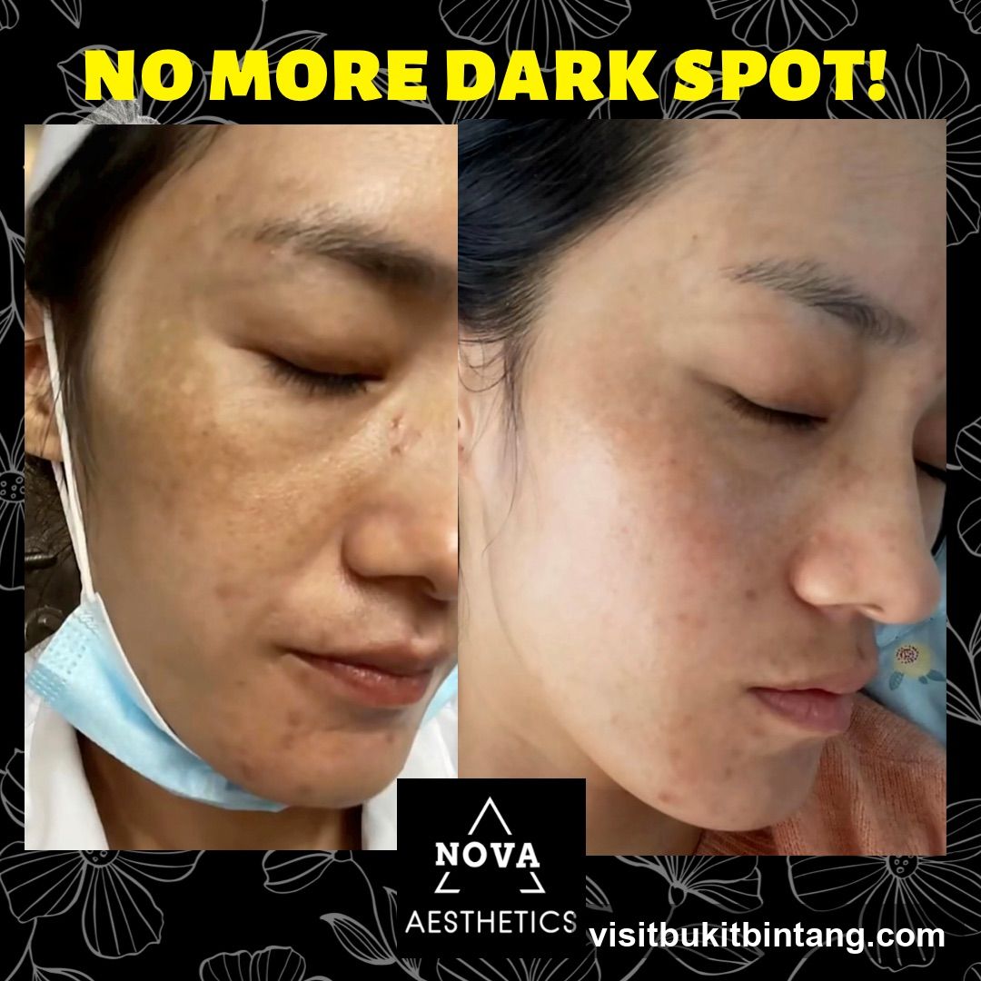 Before and After Dark Spot Treatment
