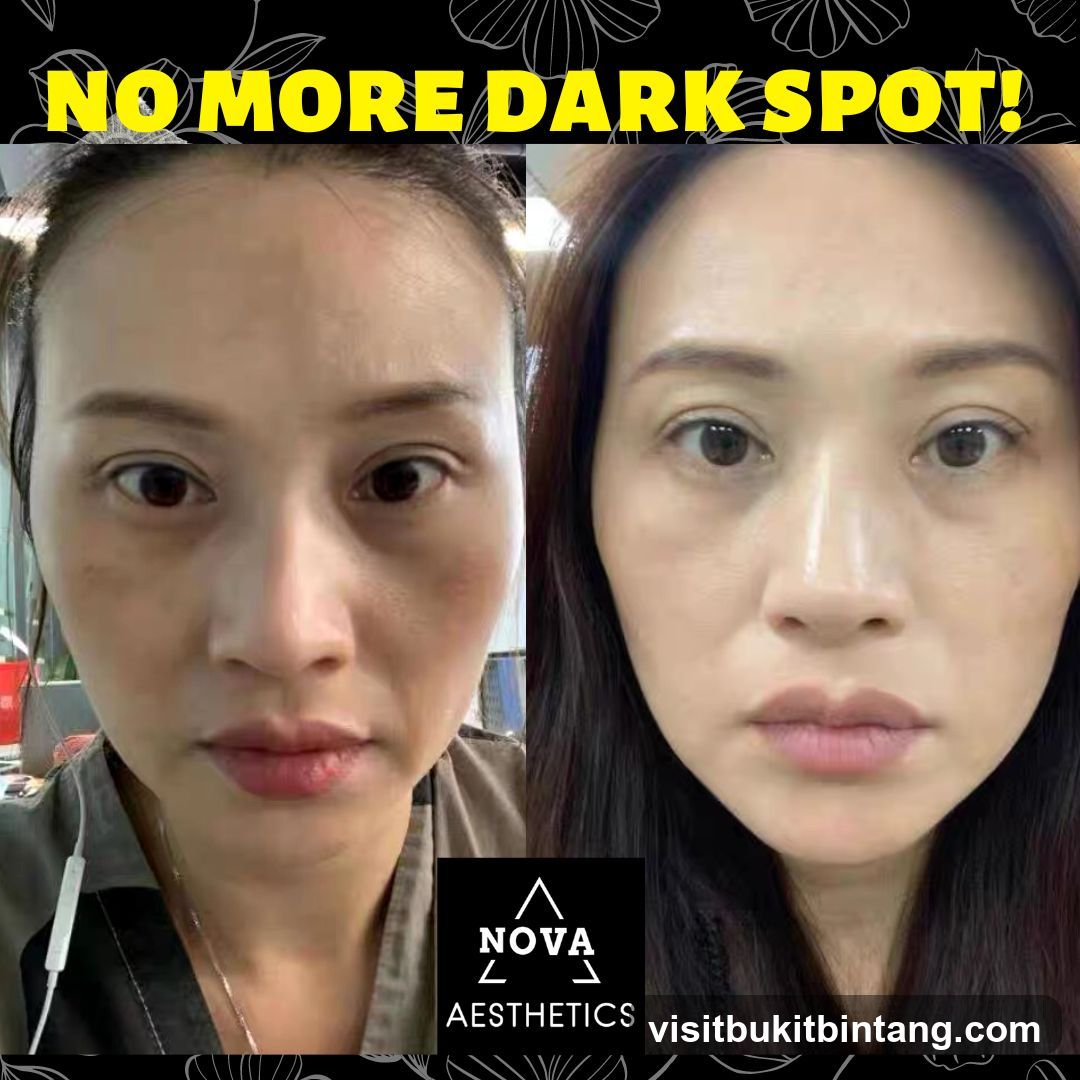 Before and After Skin Treatment