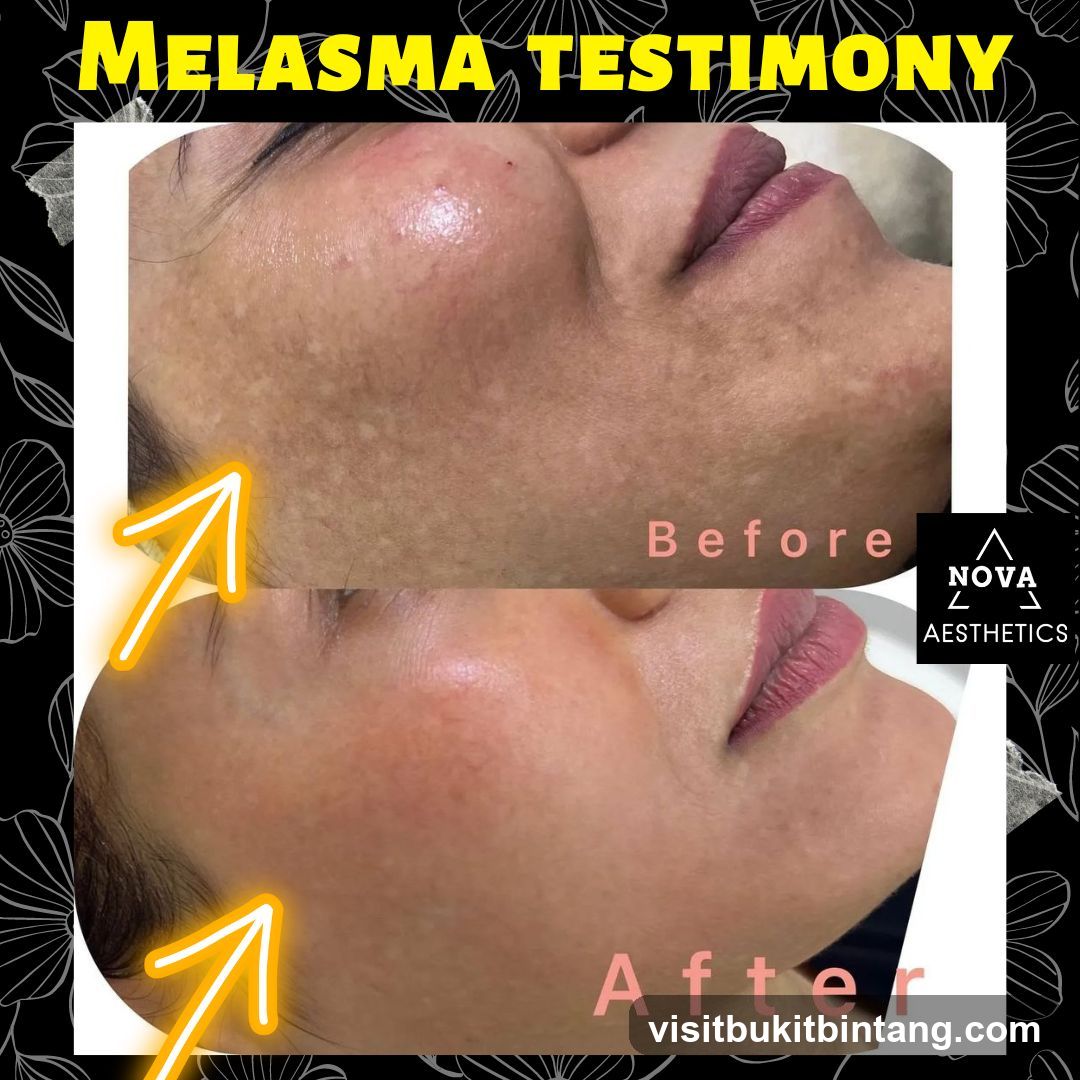 Melasma Testimony