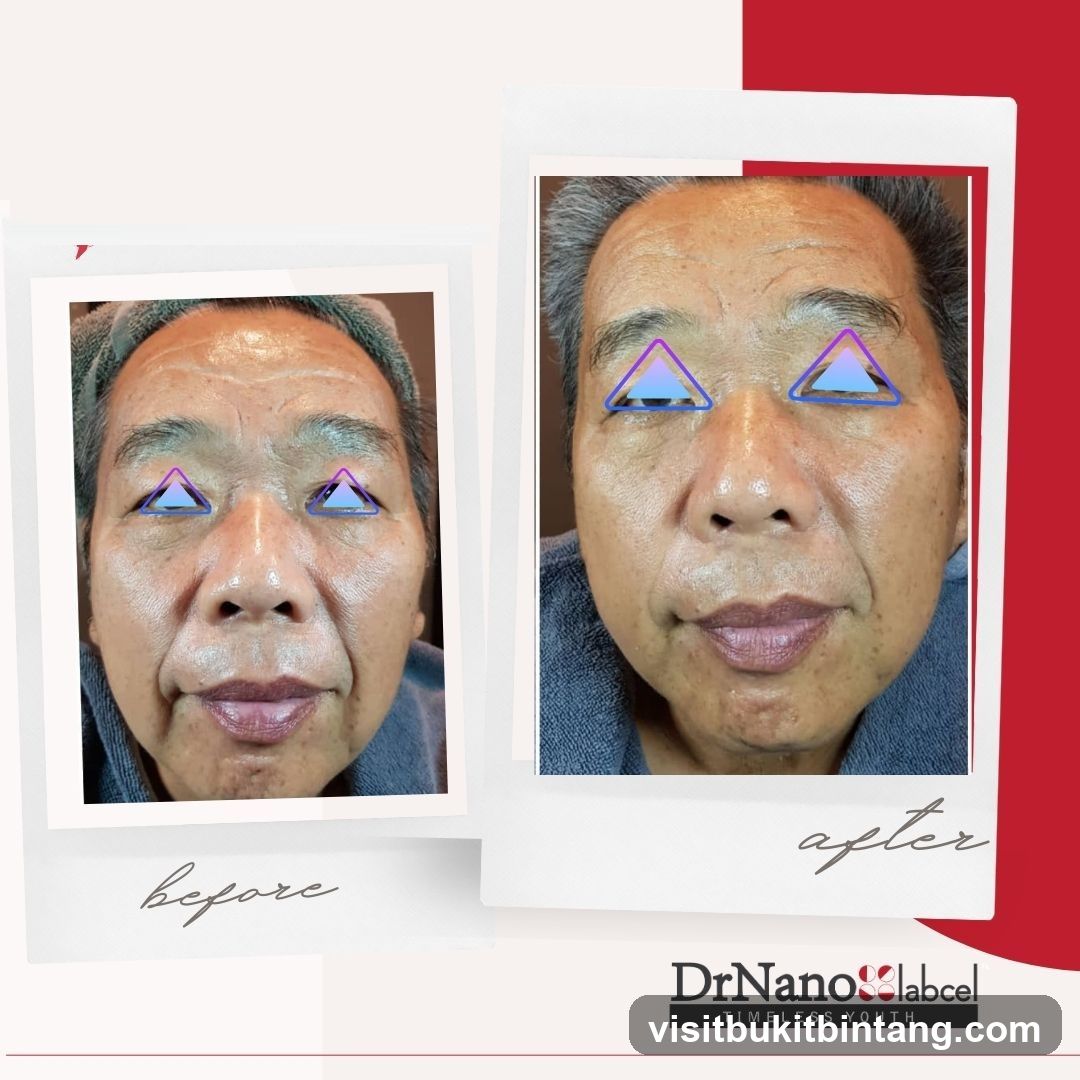 Before and After Facial Treatment