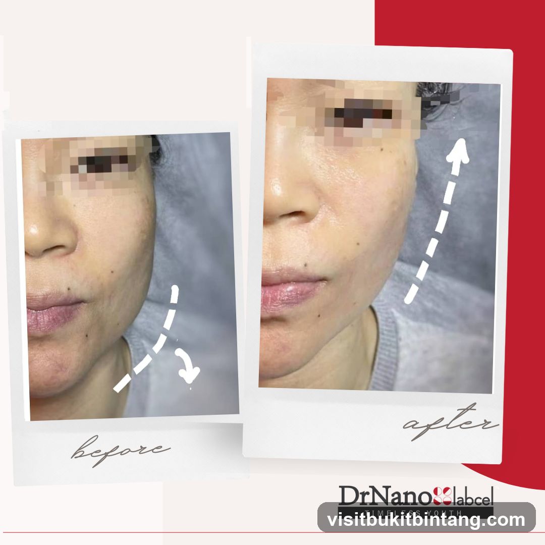 Before and After Facial Treatment
