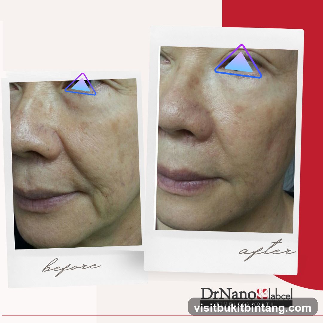 Before and After Skin Treatment