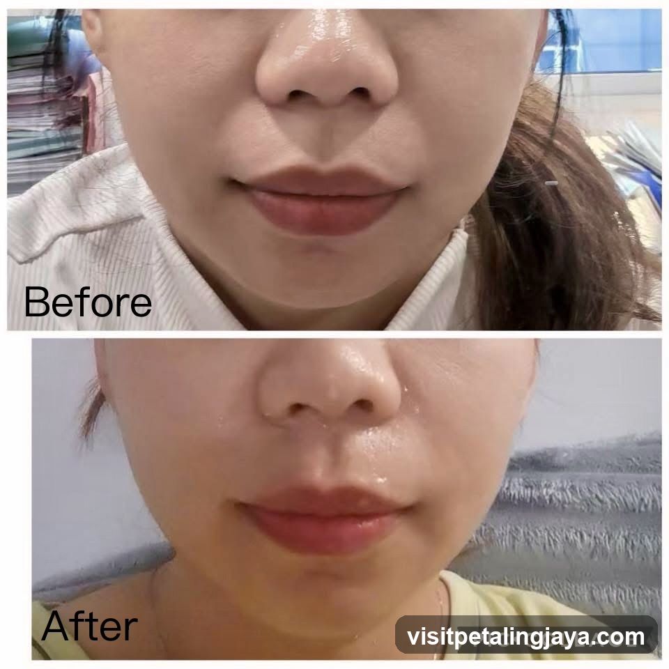 Before and After Facial Comparison