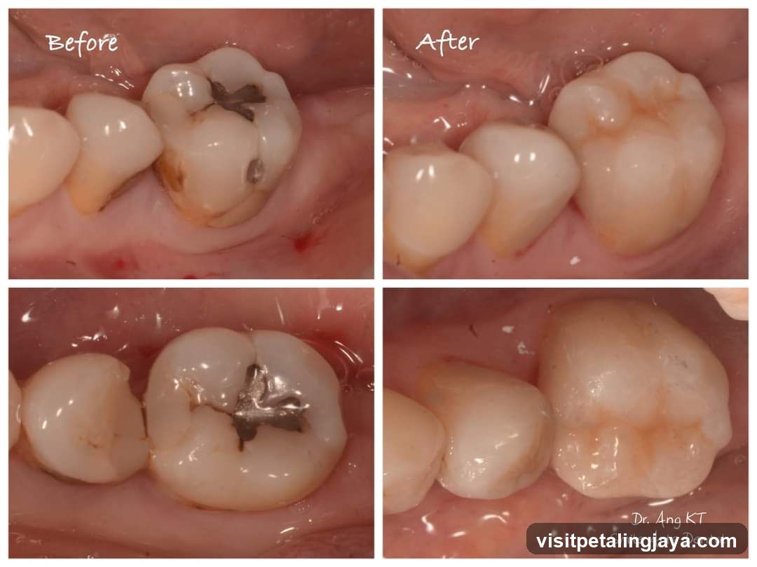 Dental Restoration Before and After