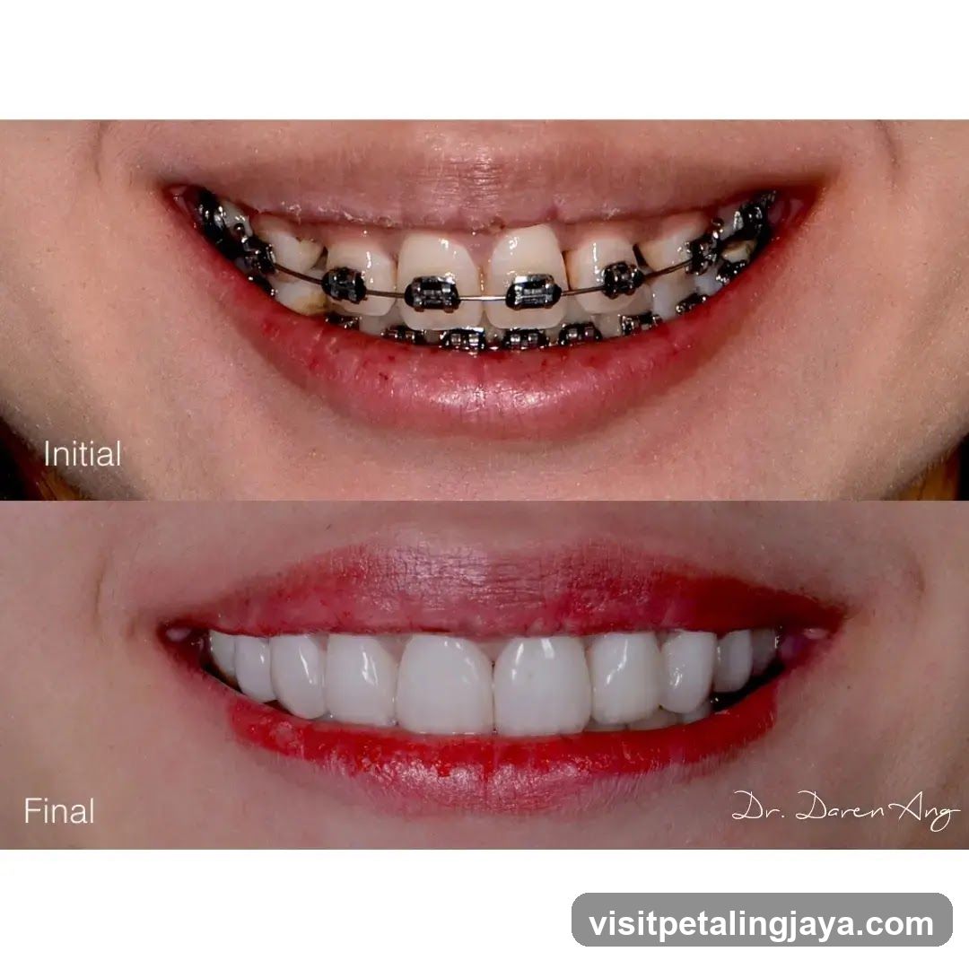 Teeth Whitening Before and After