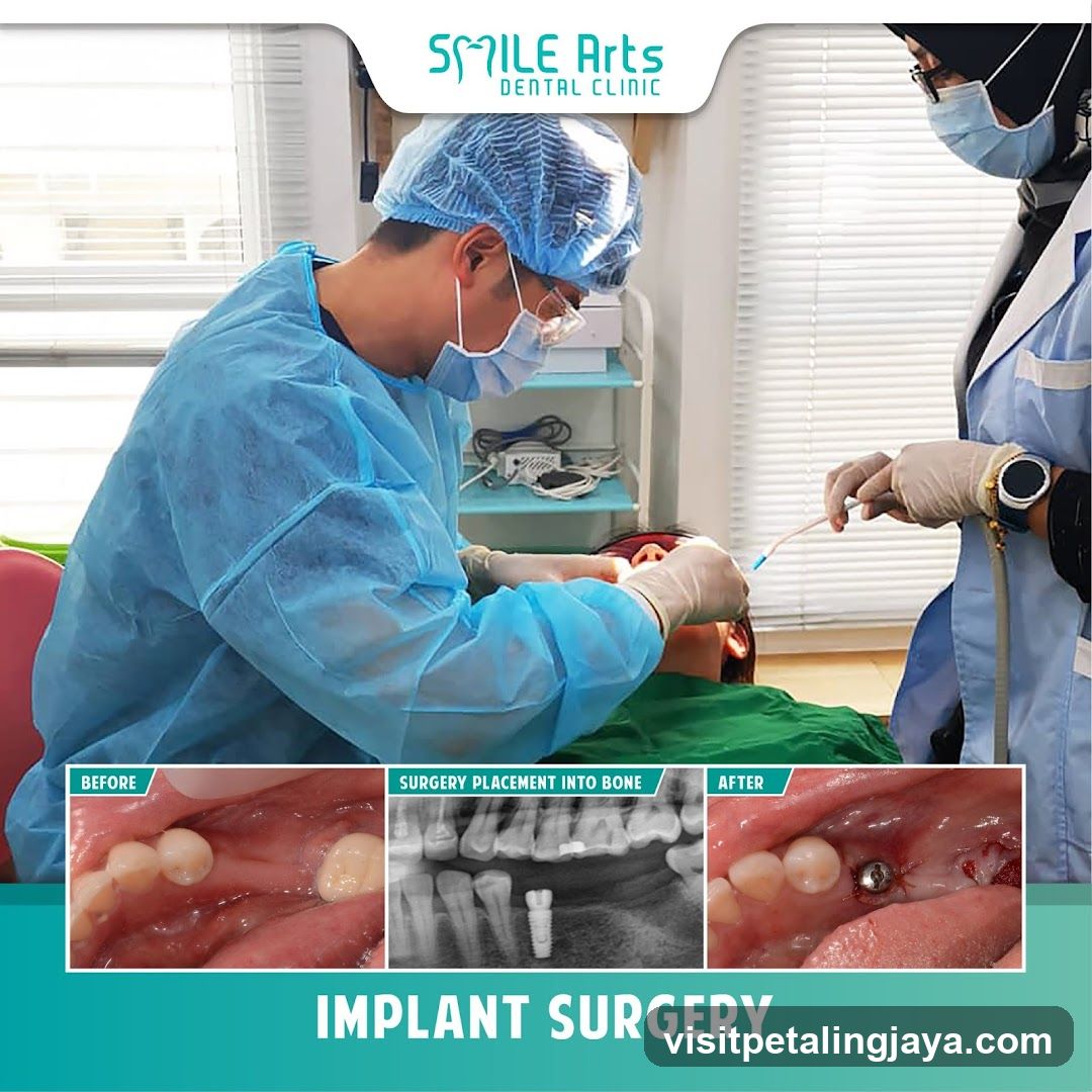 Implant Surgery