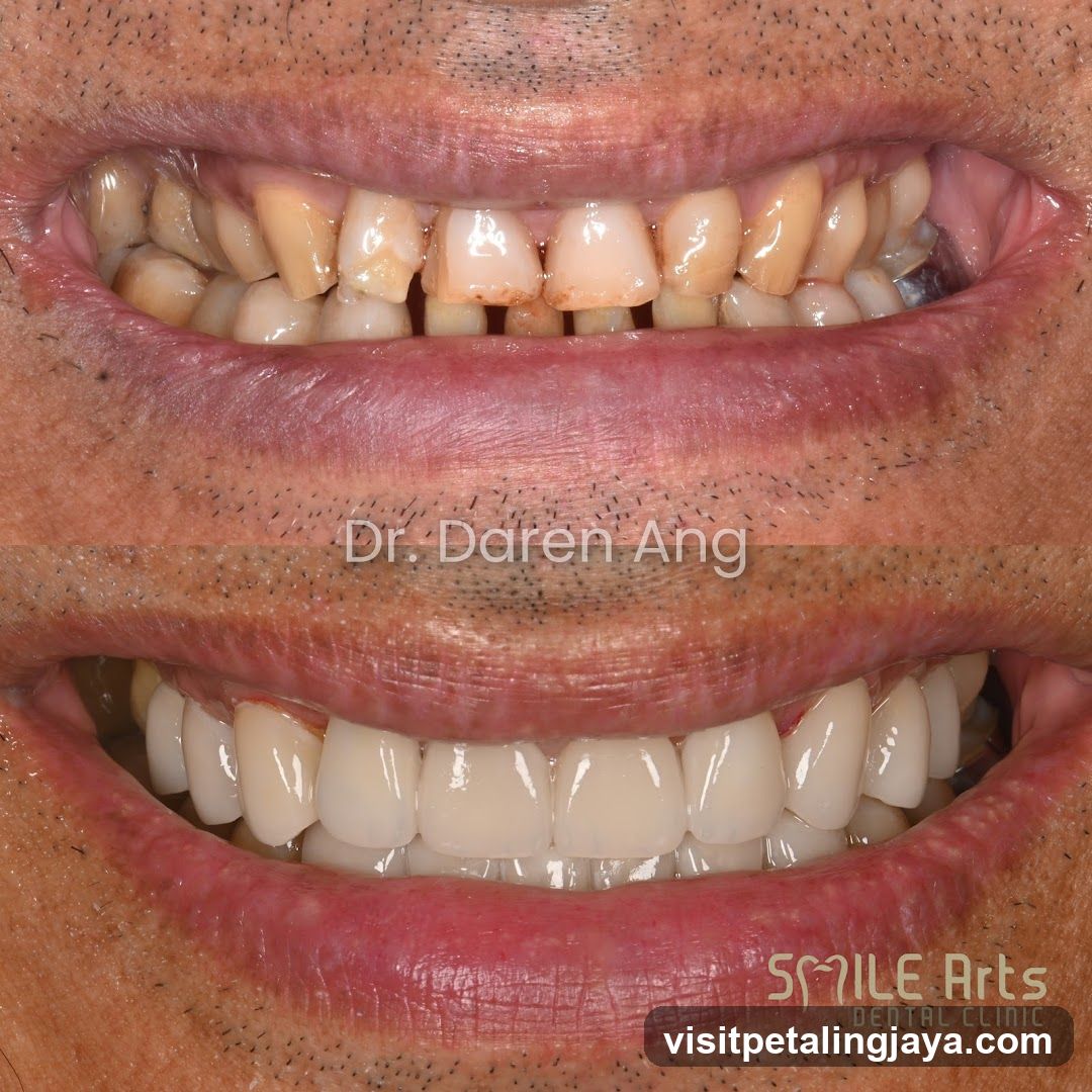 Dental Before and After Smile Transformation