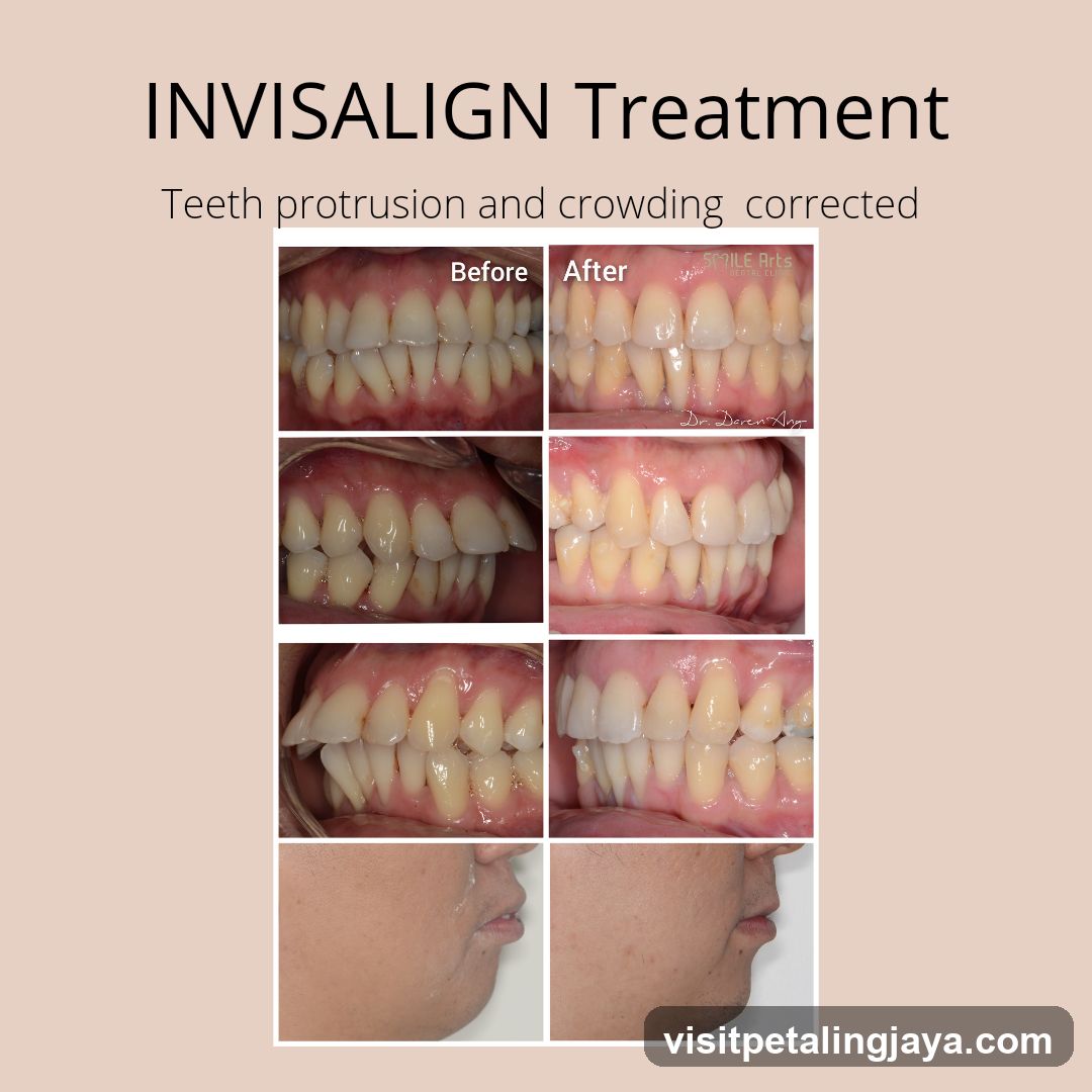 INVISALIGN Treatment