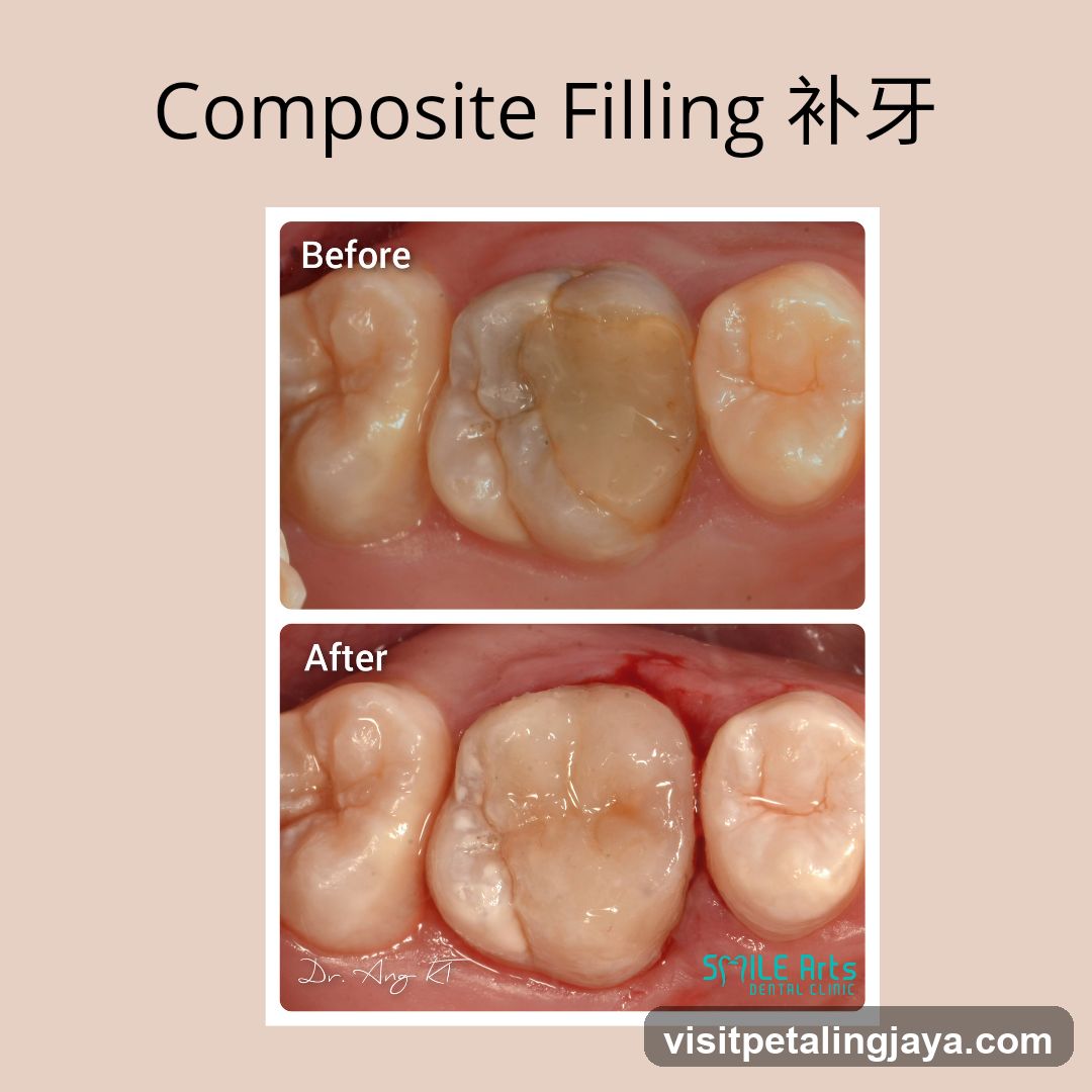 Composite Filling 补牙