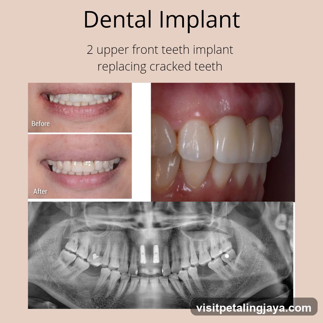 Dental Implant