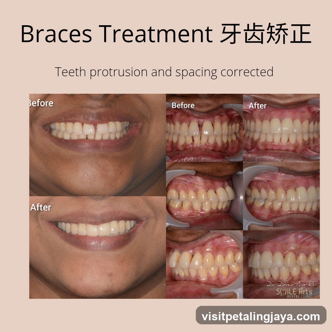 Braces Treatment 牙齿矫正