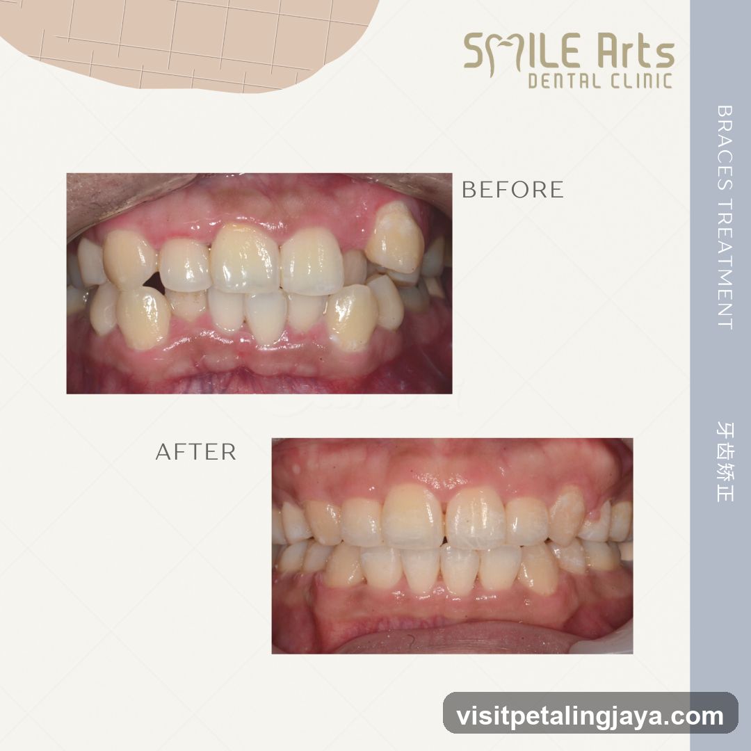 Smile Arts Dental Clinic - Braces Treatment Before and After