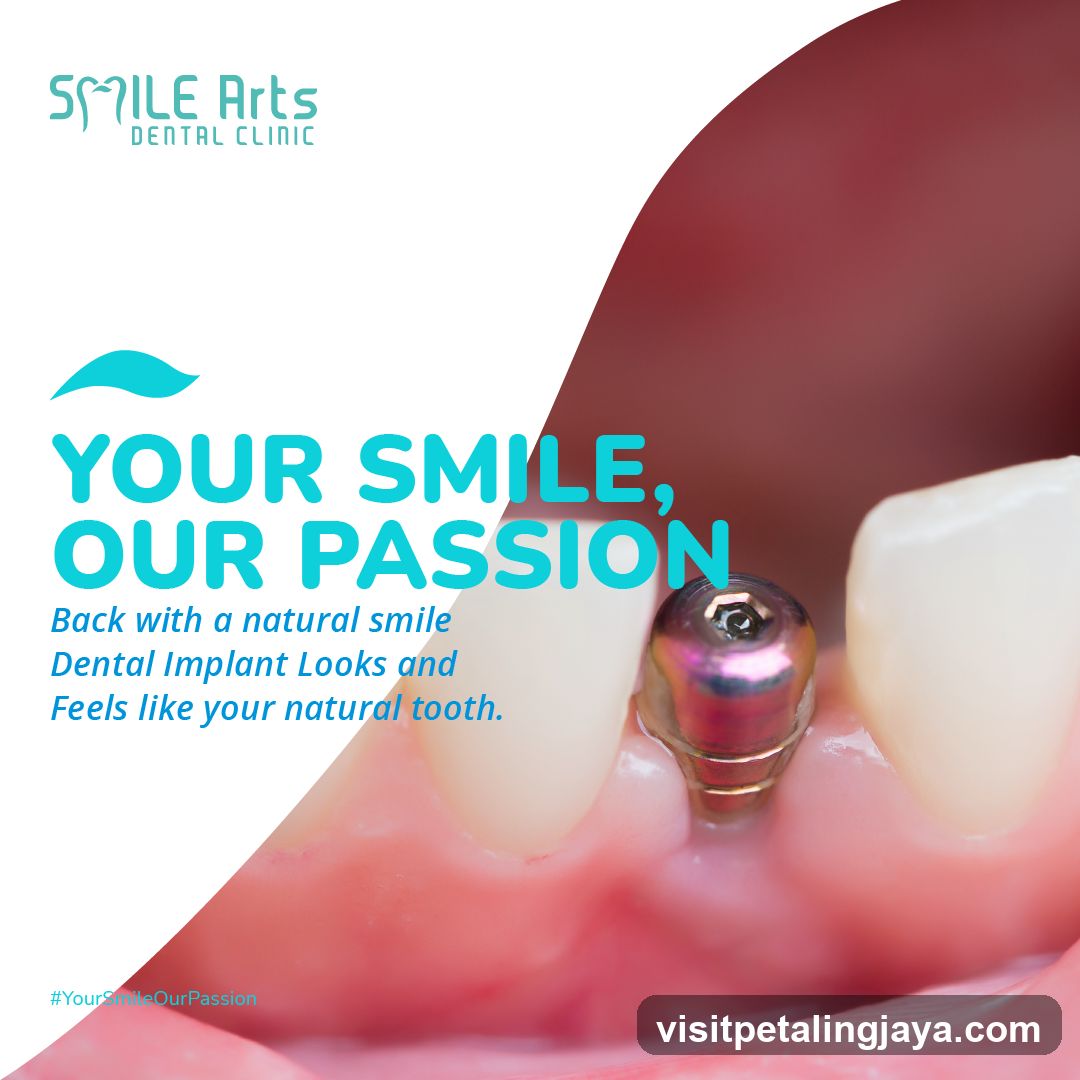 Dental Implant Advertisement